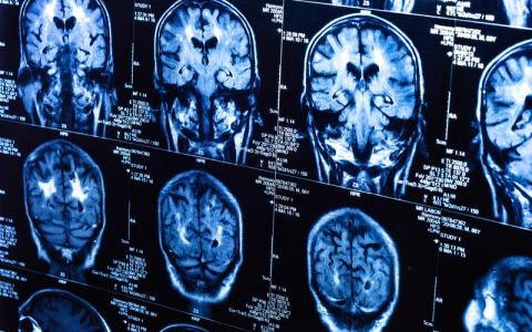 Meningitis Symptoms meningitis-symptoms