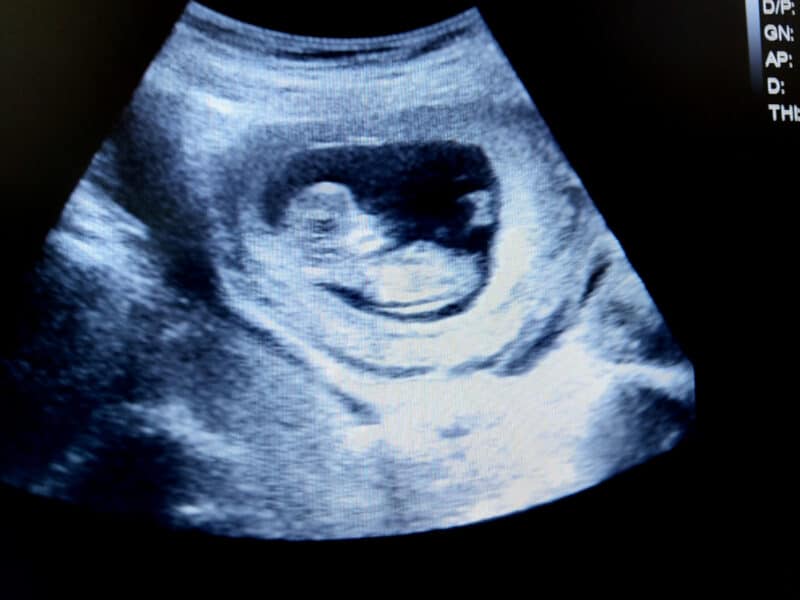 11 weeks pregnant ultrasound