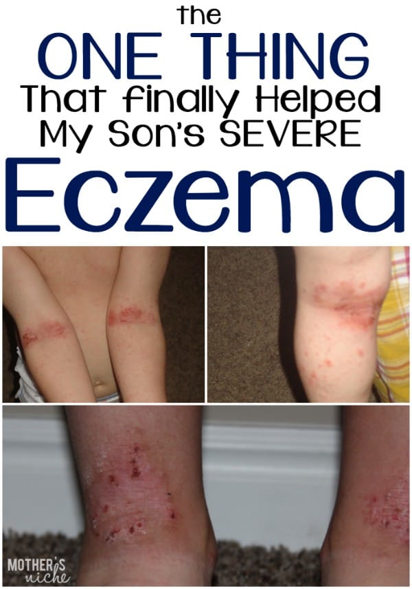 After trying all sorts of creams, essential oils, etc, we FINALLY found something that took away my son's eczema!