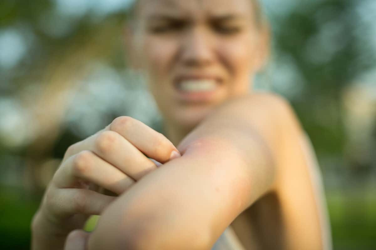 mosquito bite