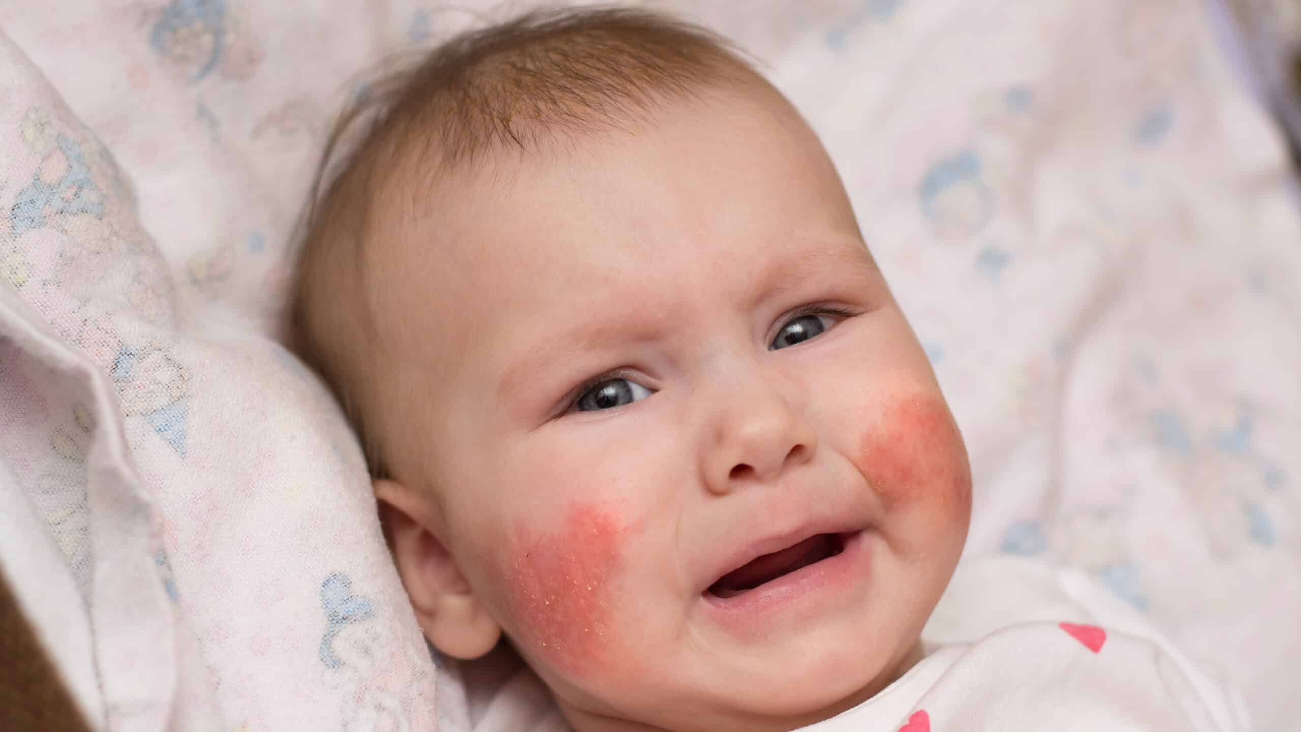 Baby with eczema on cheeks.