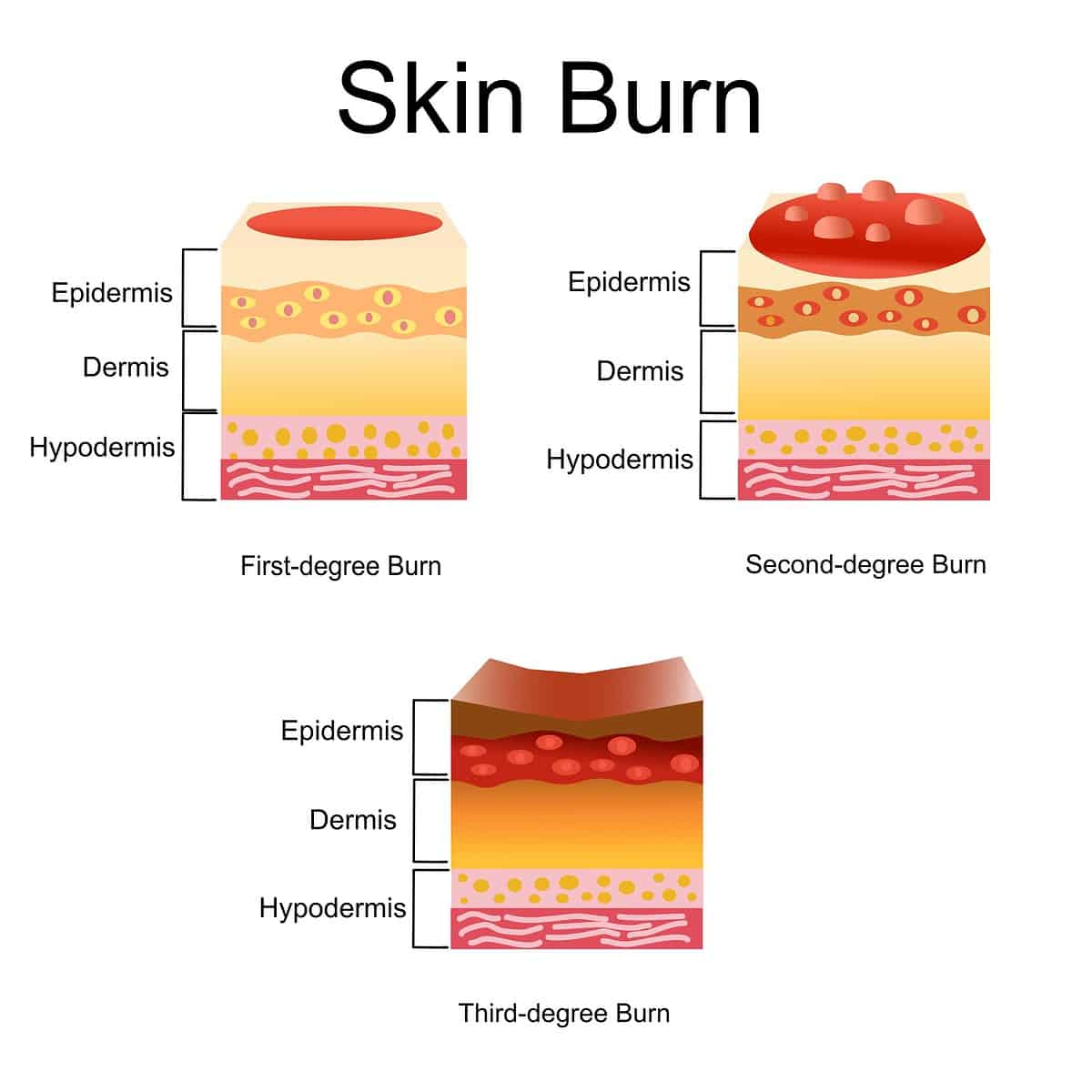 free sunburn severity chart