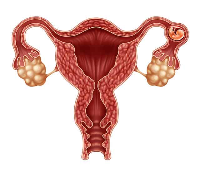 Ectopic Pregnancy Symptoms