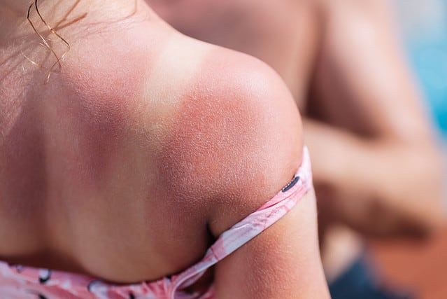the red back of a girl with a sunburn and white lines from a swimsuit with a hotel pool on the background.