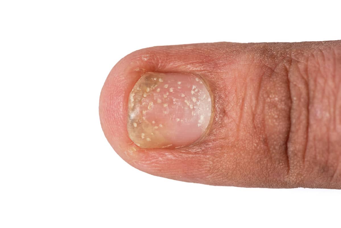 Psoriasis at the nail. Psoriasis is an autoimmune disease that affects the nail, close up of Psoriasis nail on white background.