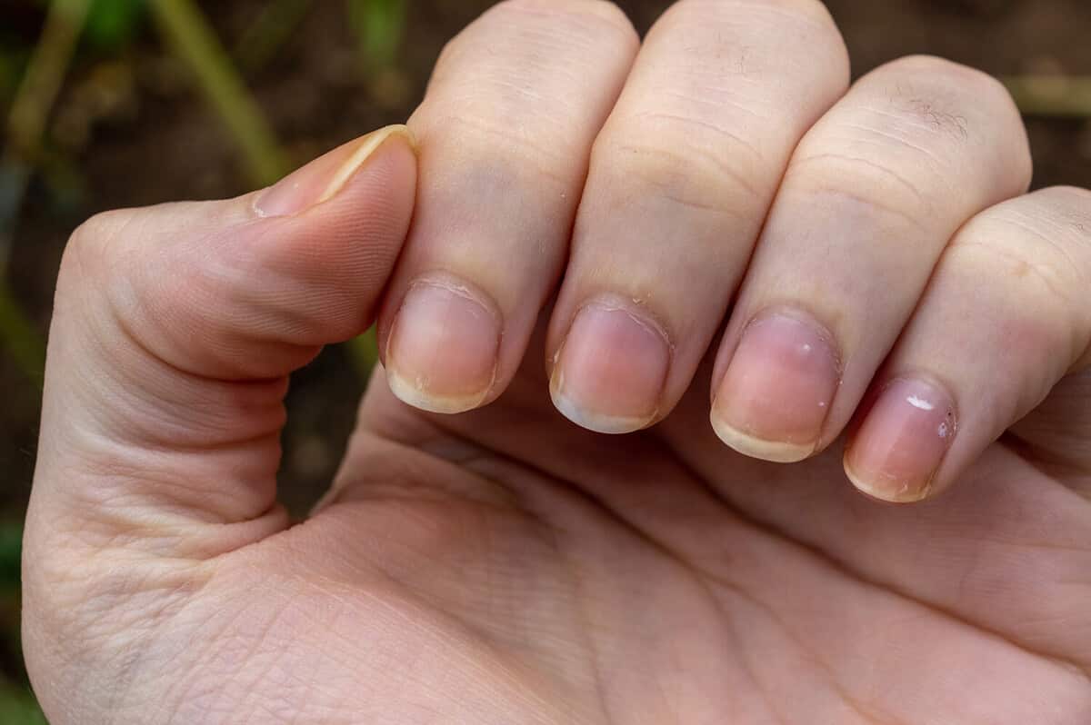 Dry, cracked yellow nails. Nails with white spots, lack of calcium. Leukonychia.
