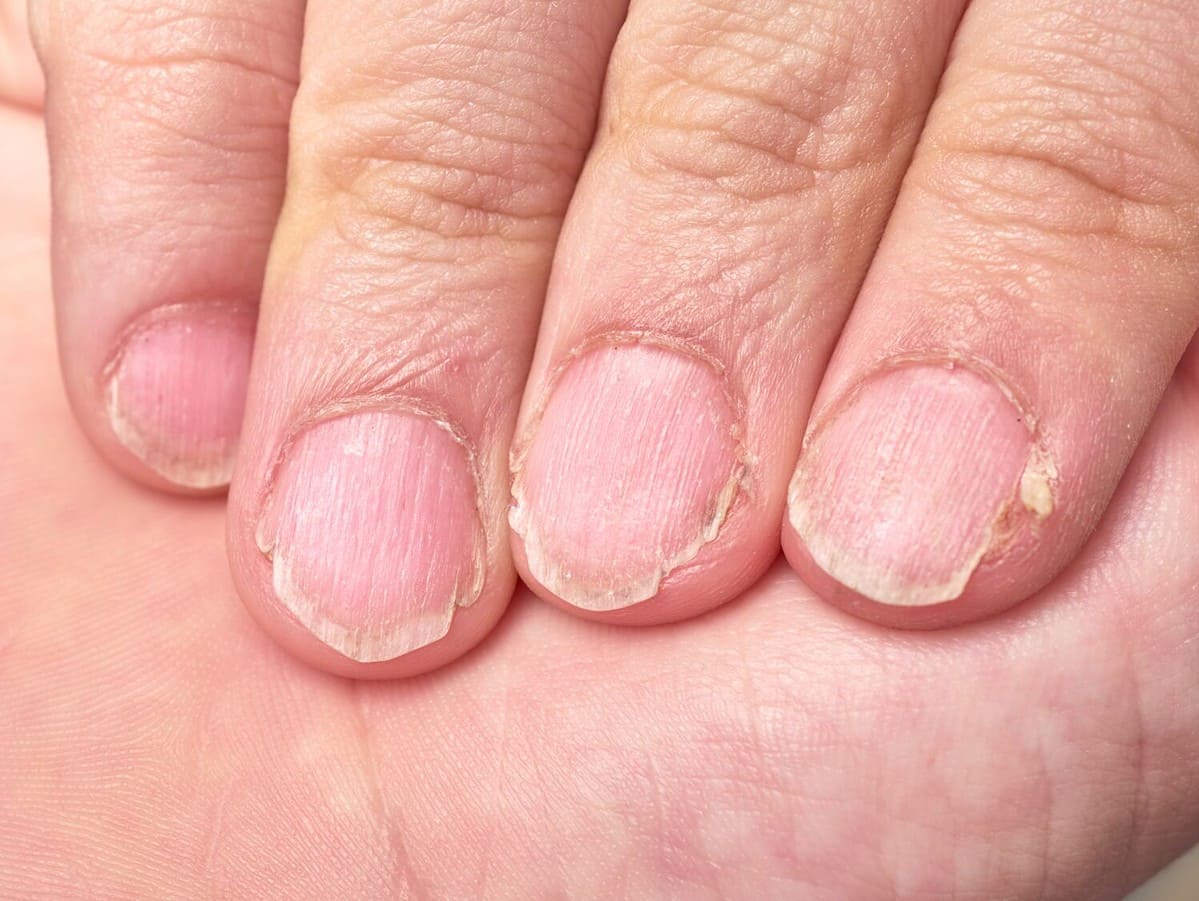 What your NAILS say about your health, according to an expert | Daily Mail  Online