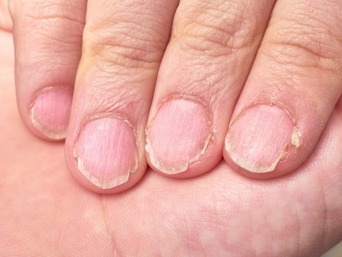 Black Lines on Nails: Causes and Treatments | POPSUGAR Beauty