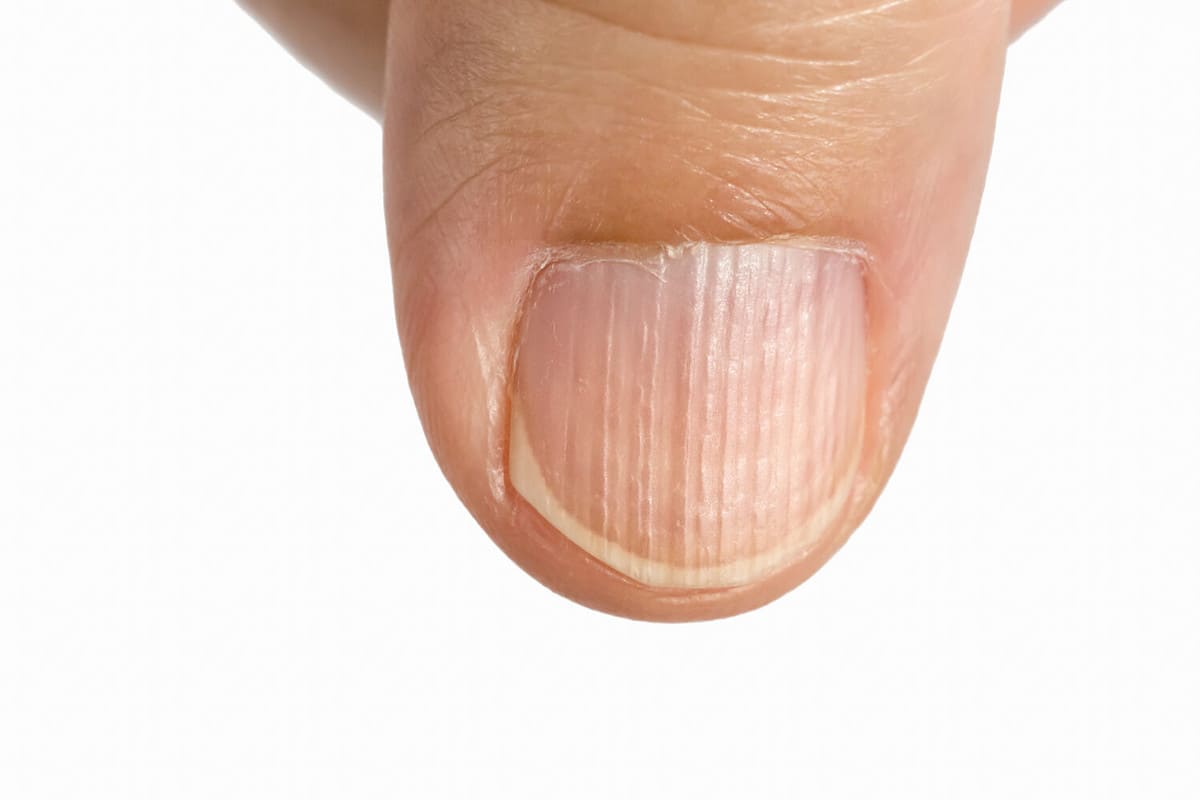 Vertical ridges on the fingernails symptoms deficiency vitamins and minerals