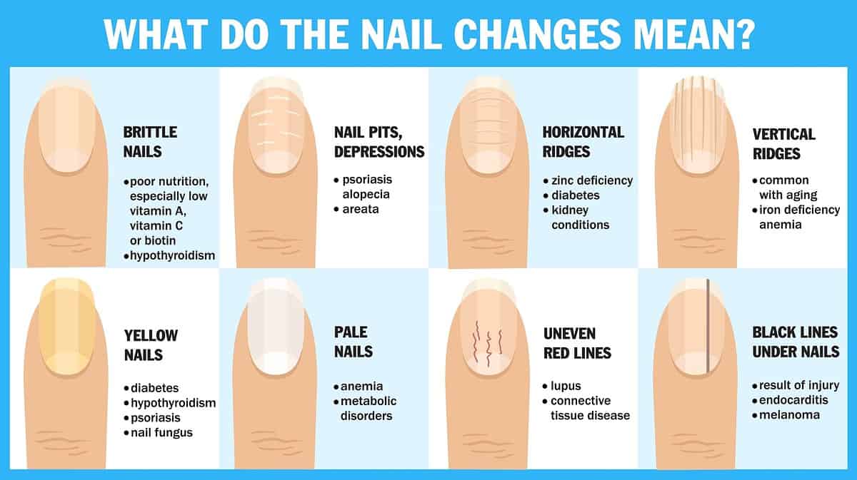 What causes a spoon nail, and how do you cure them? - Quora