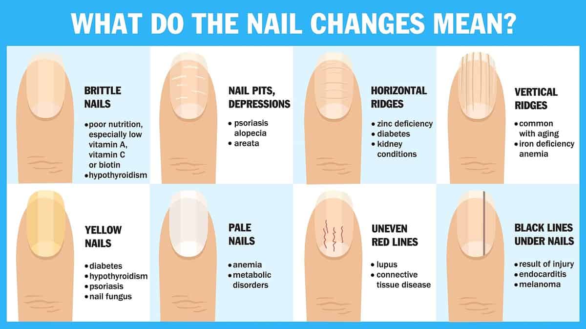 What do the nail changes mean? The appearance of the nail and the associated disease. Brittle nails, nail pits, depression, horizontal, vertical ridge. Medical infographic design. Vector illustration