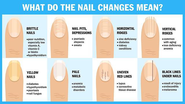 Nail Health Chart: How To Identify Problems
