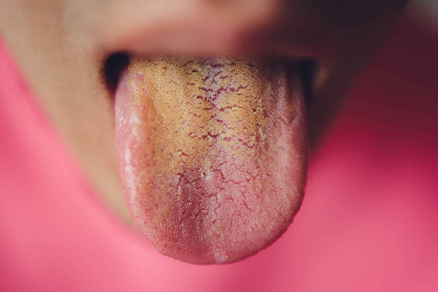 dirty tongue, close-up, yellow due to illness.