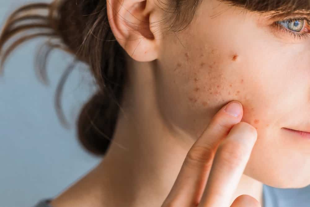 Woman with red cheeks- diathesis or allergy symptoms. Redness and peeling of the skin on the face. Teenage girl with acne problem on beige background, closeup.