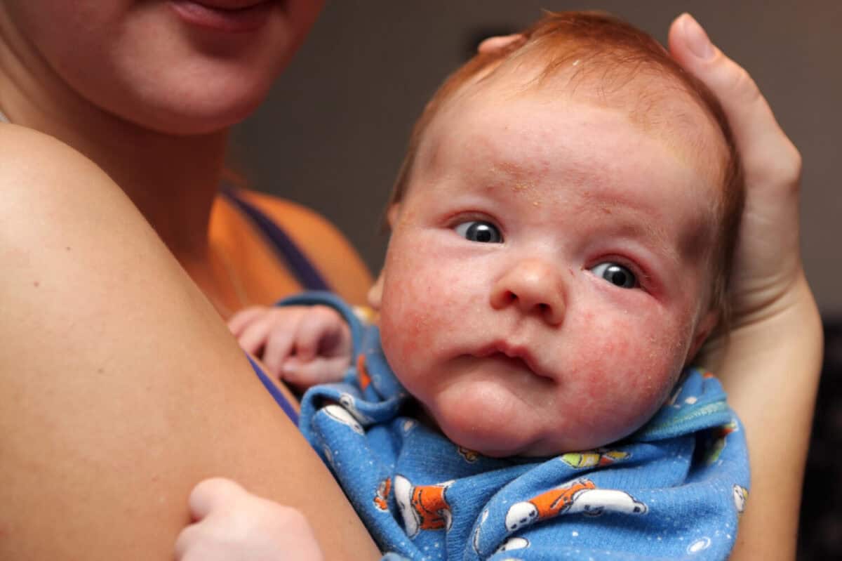 The 10 Best Treatment Options for Baby Eczema