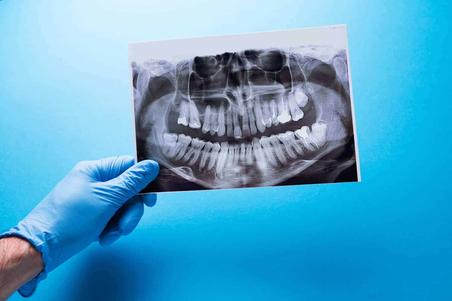 Opting Out of Taking X-Rays