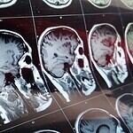 Fast Food Can Shrink the Brain