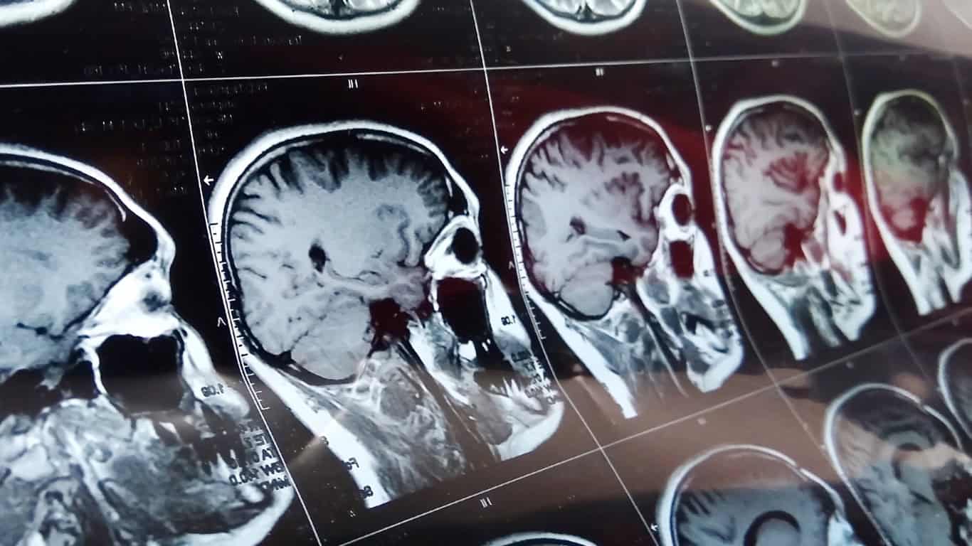 Fast Food Can Shrink the Brain