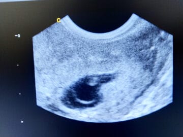 A 4-weeks pregnant ultrasound shows an embryo in the amniotic sac.