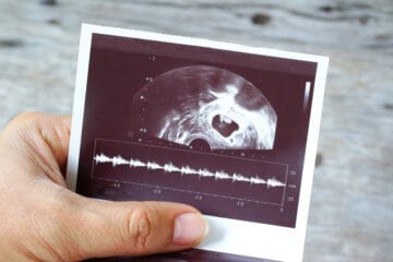 5 weeks pregnant ultrasound